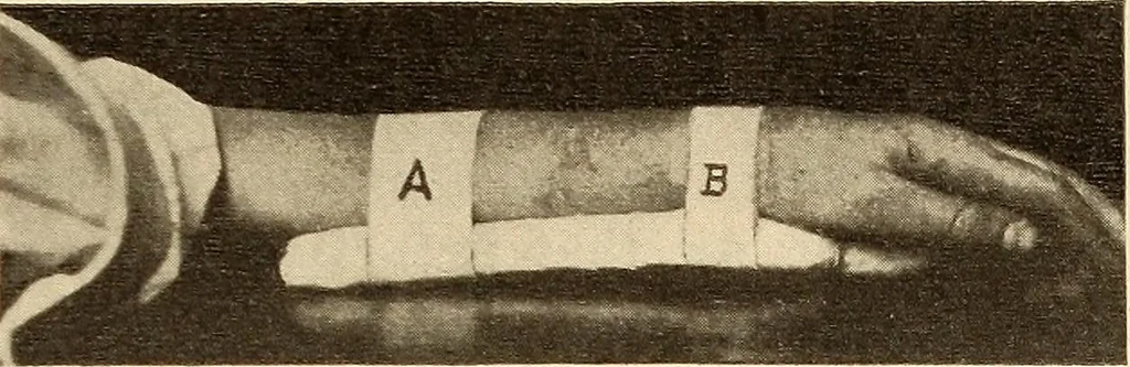 An illustration from Fractures and dislocations, diagnosis and treatment, 1915, leaf 254