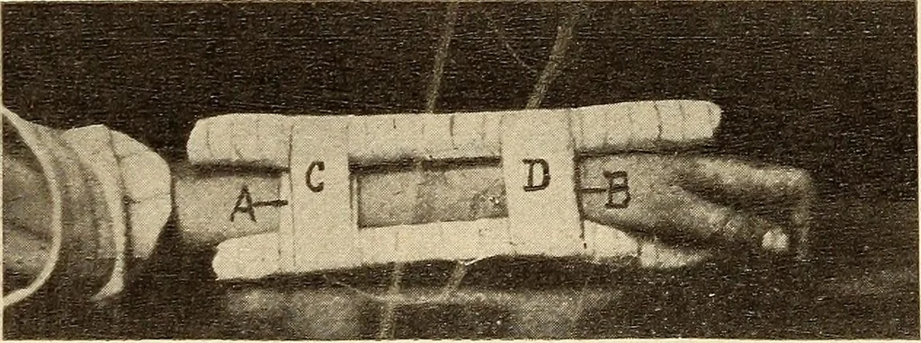 An illustration from Fractures and dislocations, diagnosis and treatment, 1915, leaf 254