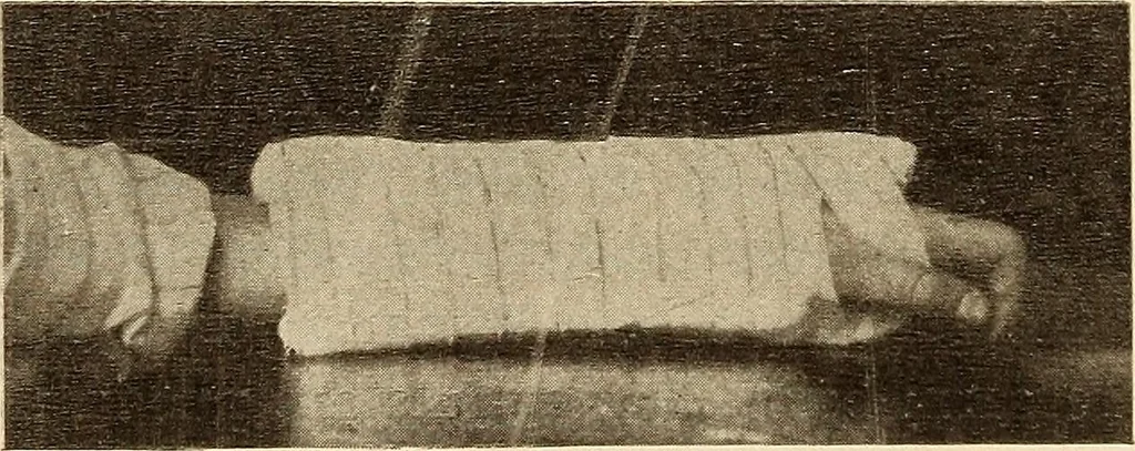 An illustration from Fractures and dislocations, diagnosis and treatment, 1915, leaf 254