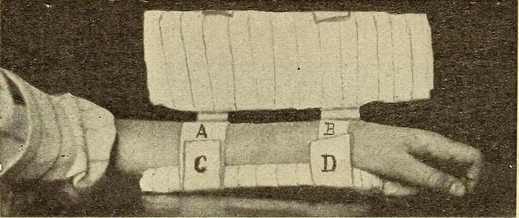 An illustration from Fractures and dislocations, diagnosis and treatment, 1915, leaf 255