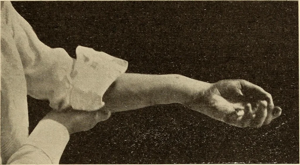 An illustration from Fractures and dislocations, diagnosis and treatment, 1915, leaf 264