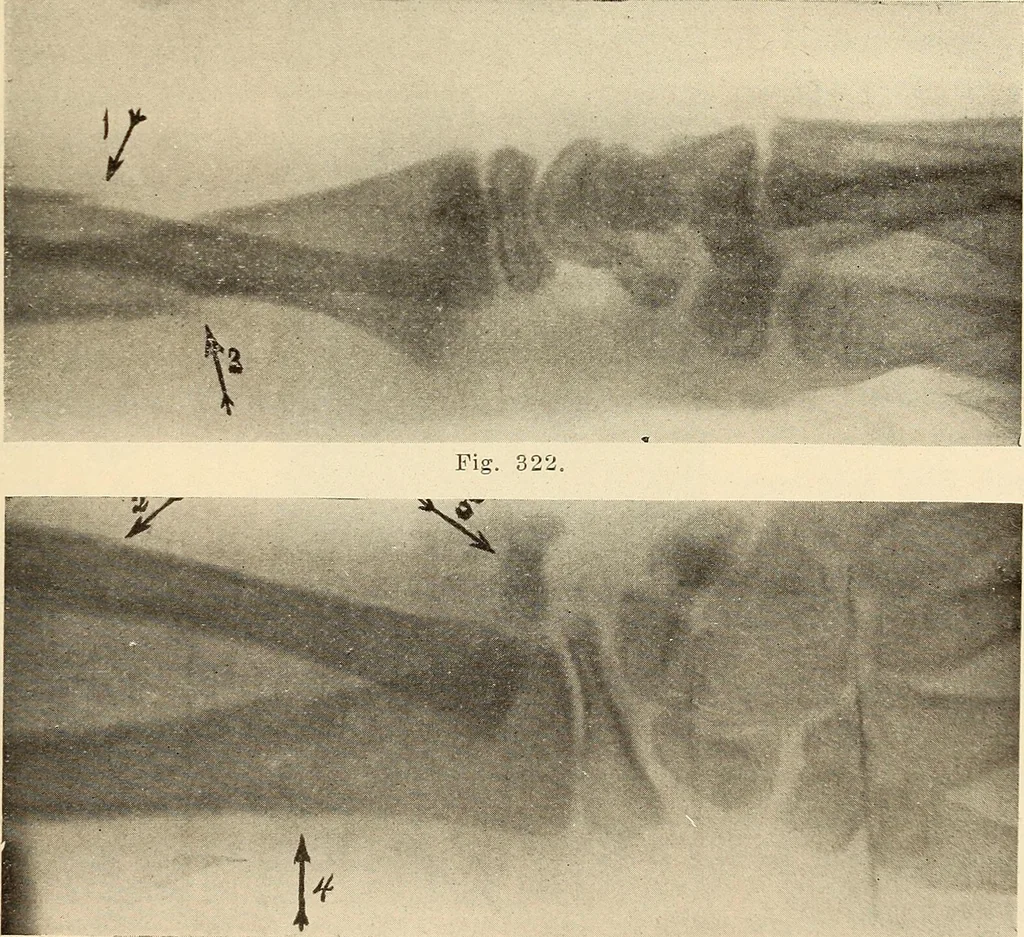 An illustration from Fractures and dislocations, diagnosis and treatment, 1915, leaf 264