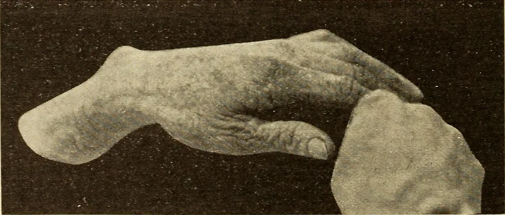 An illustration from Fractures and dislocations, diagnosis and treatment, 1915, leaf 269