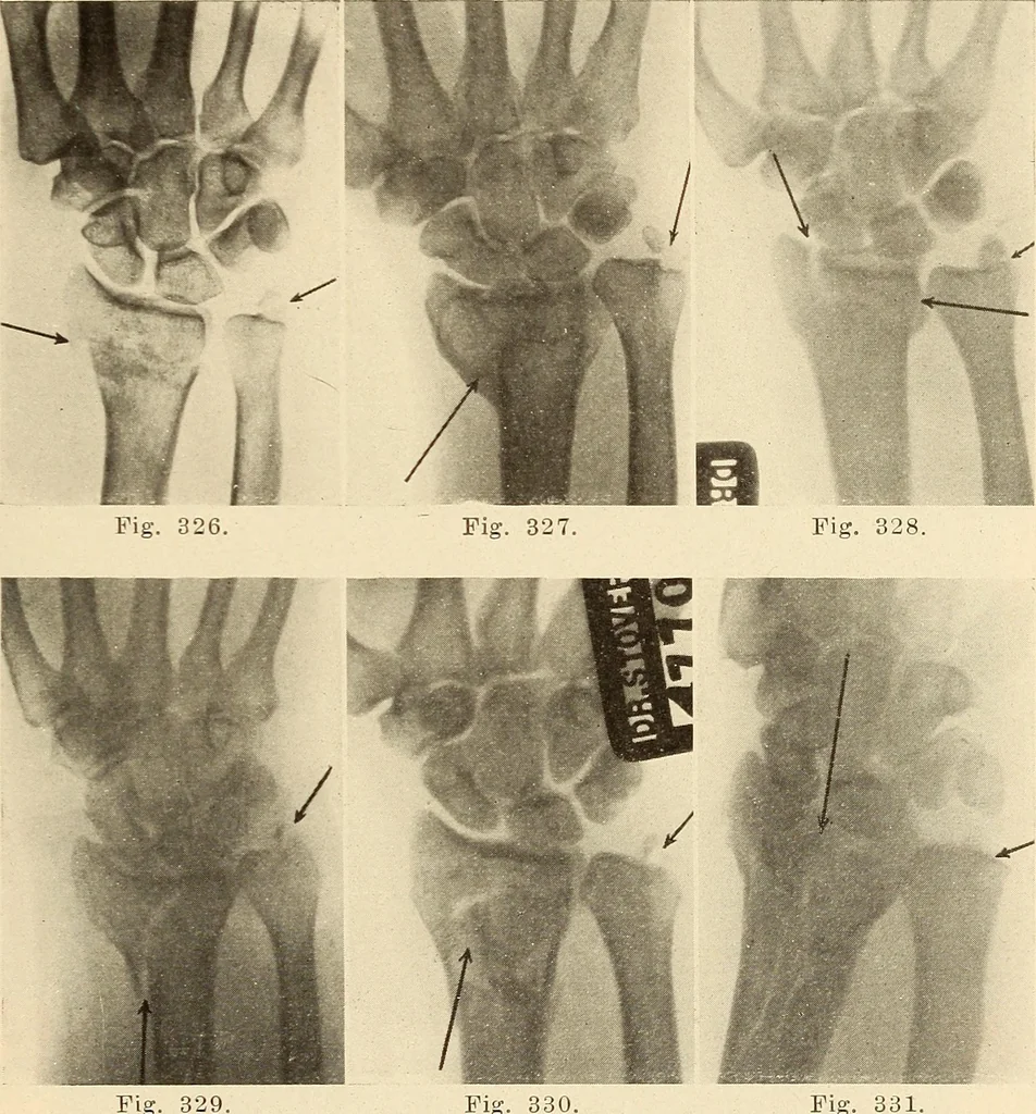An illustration from Fractures and dislocations, diagnosis and treatment, 1915, leaf 274