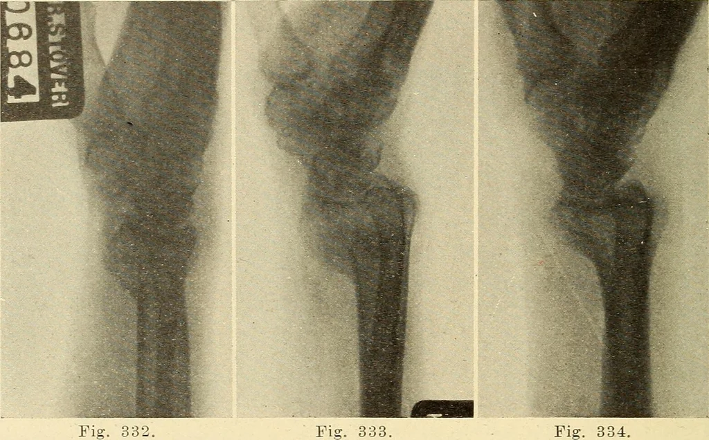 An illustration from Fractures and dislocations, diagnosis and treatment, 1915, leaf 275