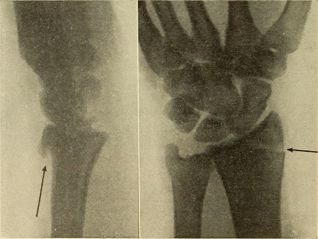 An illustration from Fractures and dislocations, diagnosis and treatment, 1915, leaf 275