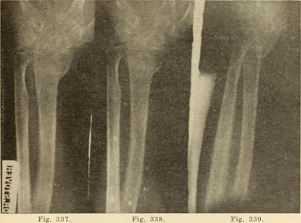 An illustration from Fractures and dislocations, diagnosis and treatment, 1915, leaf 276