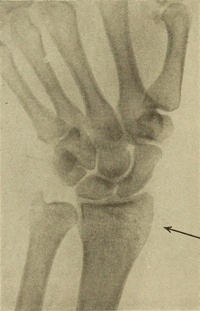 An illustration from Fractures and dislocations, diagnosis and treatment, 1915, leaf 277