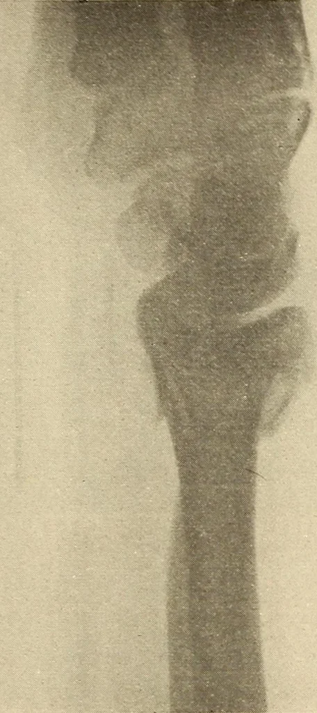 An illustration from Fractures and dislocations, diagnosis and treatment, 1915, leaf 278