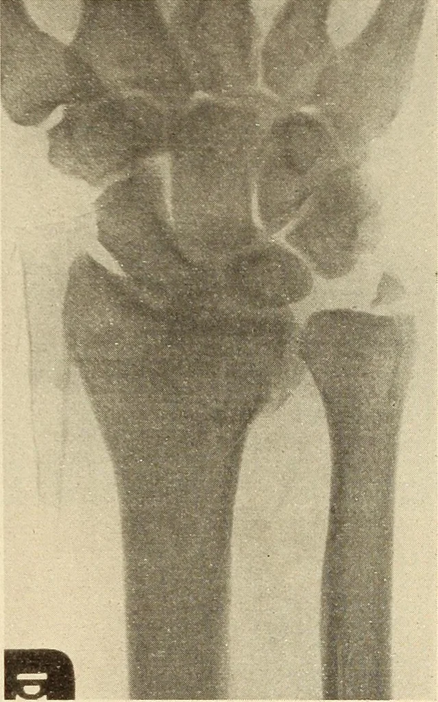 An illustration from Fractures and dislocations, diagnosis and treatment, 1915, leaf 278