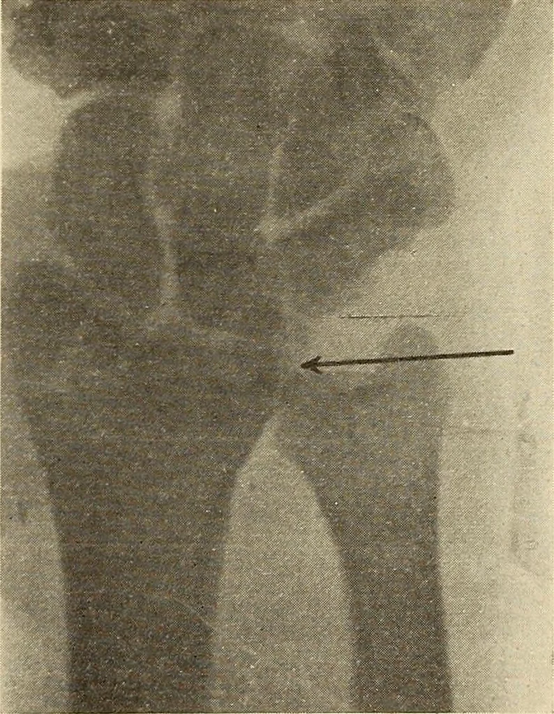 An illustration from Fractures and dislocations, diagnosis and treatment, 1915, leaf 278