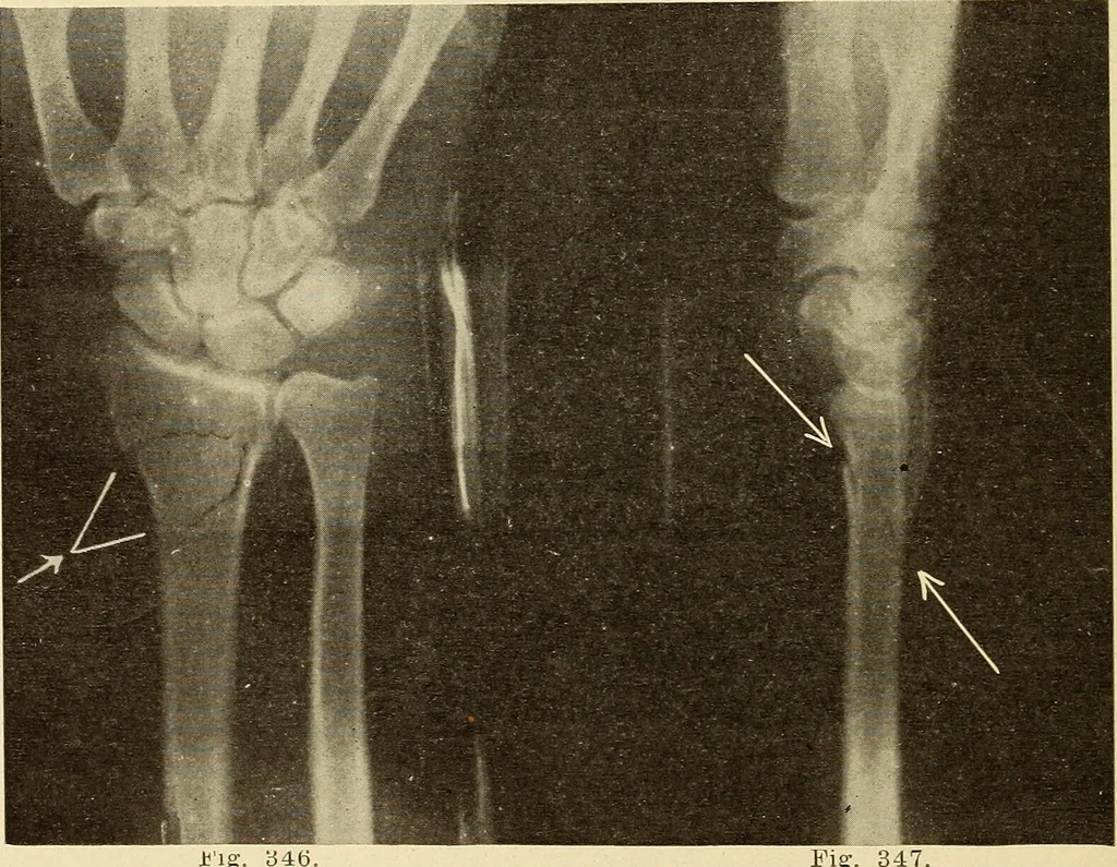 An illustration from Fractures and dislocations, diagnosis and treatment, 1915, leaf 279