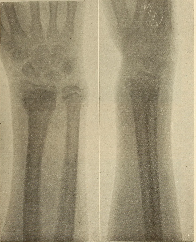 An illustration from Fractures and dislocations, diagnosis and treatment, 1915, leaf 280