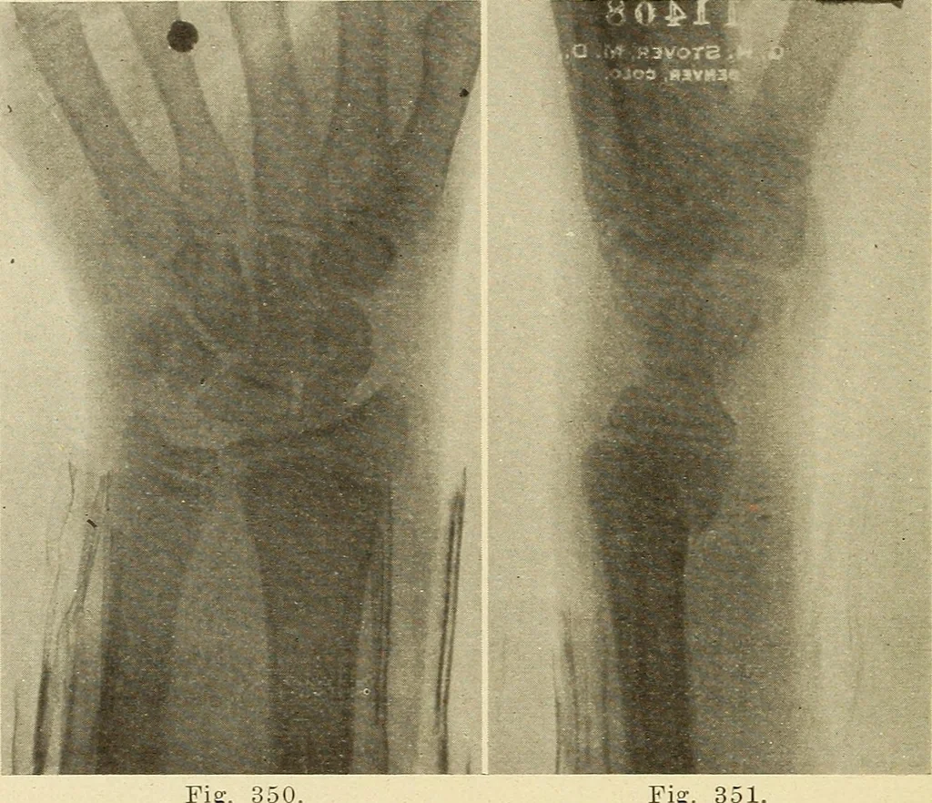 An illustration from Fractures and dislocations, diagnosis and treatment, 1915, leaf 281