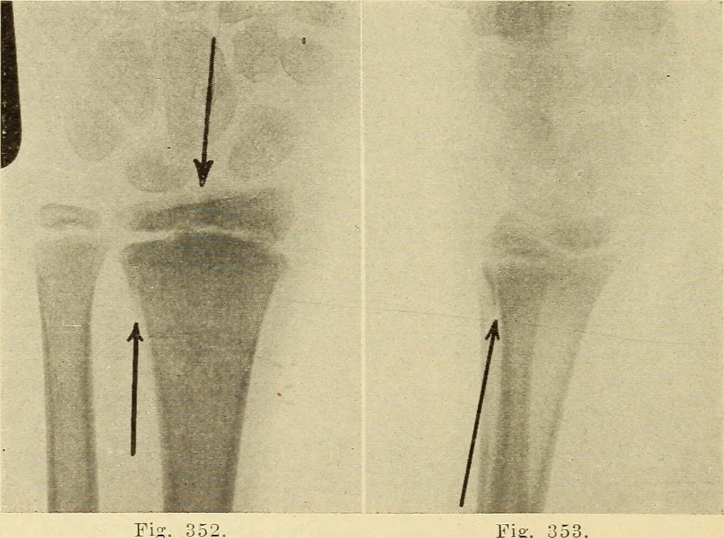 An illustration from Fractures and dislocations, diagnosis and treatment, 1915, leaf 281