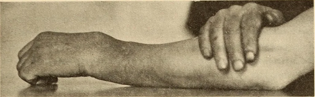 An illustration from Fractures and dislocations, diagnosis and treatment, 1915, leaf 286