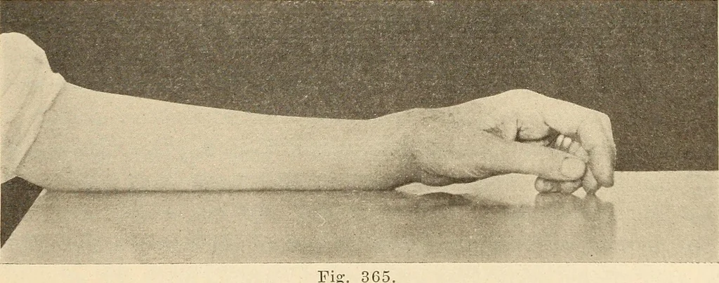An illustration from Fractures and dislocations, diagnosis and treatment, 1915, leaf 286