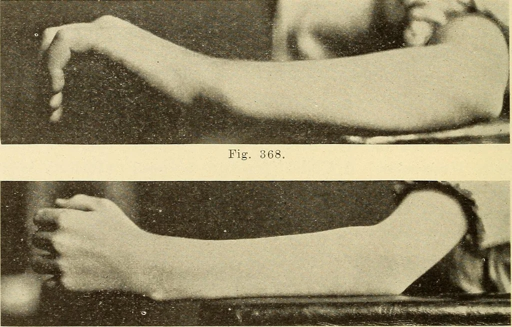 An illustration from Fractures and dislocations, diagnosis and treatment, 1915, leaf 289
