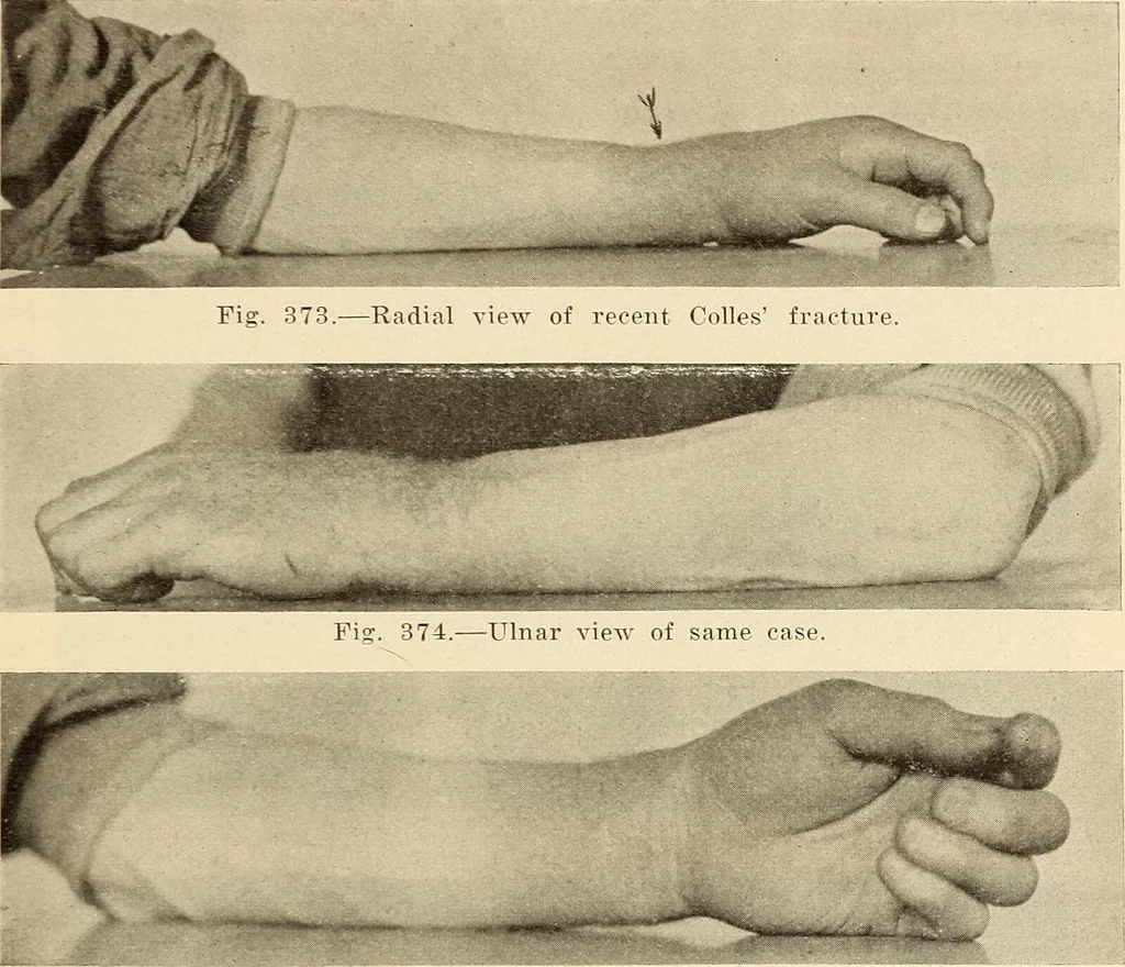 An illustration from Fractures and dislocations, diagnosis and treatment, 1915, leaf 292