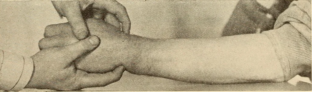 An illustration from Fractures and dislocations, diagnosis and treatment, 1915, leaf 292