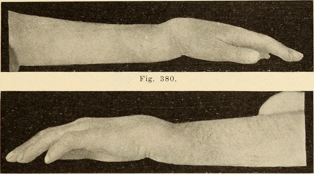 An illustration from Fractures and dislocations, diagnosis and treatment, 1915, leaf 294
