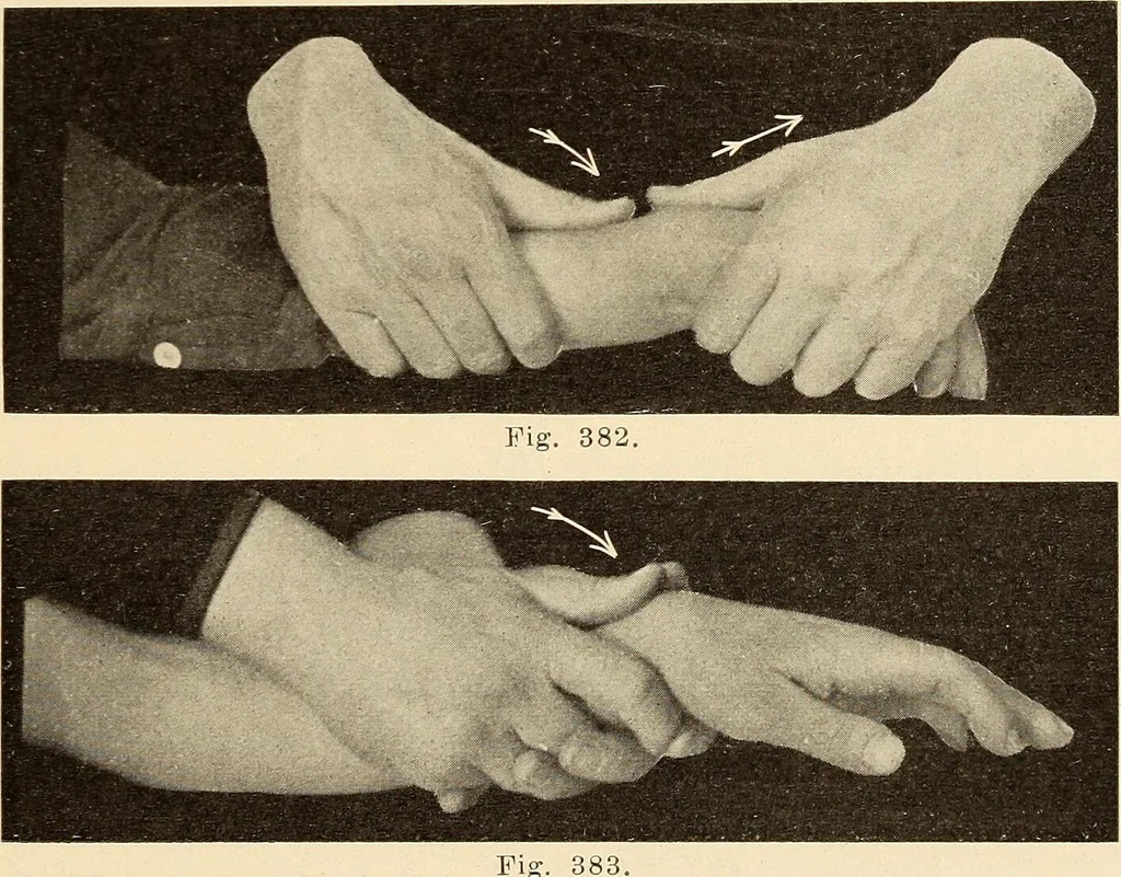 An illustration from Fractures and dislocations, diagnosis and treatment, 1915, leaf 294