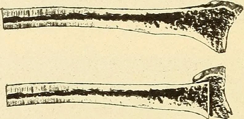 An illustration from Fractures and dislocations, diagnosis and treatment, 1915, leaf 295