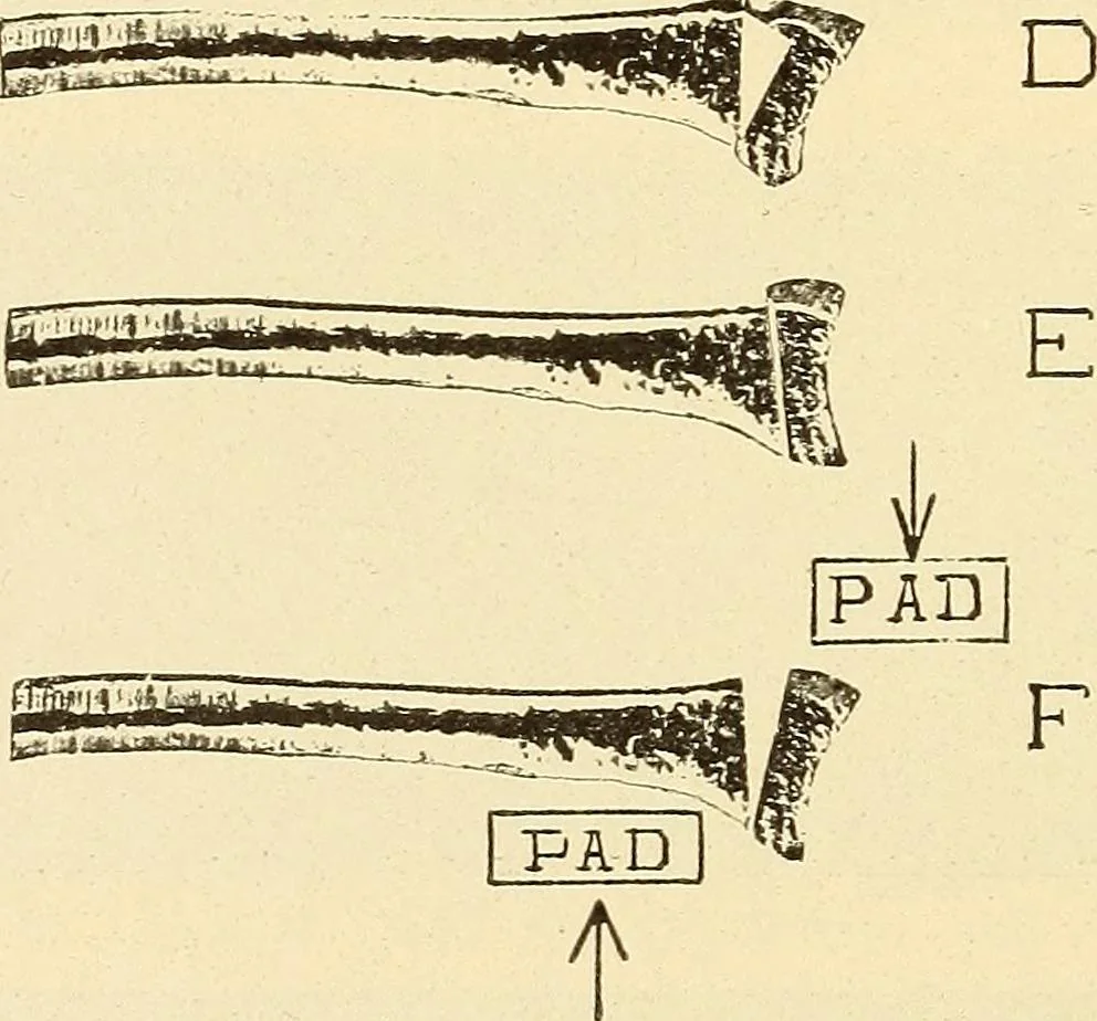 An illustration from Fractures and dislocations, diagnosis and treatment, 1915, leaf 295