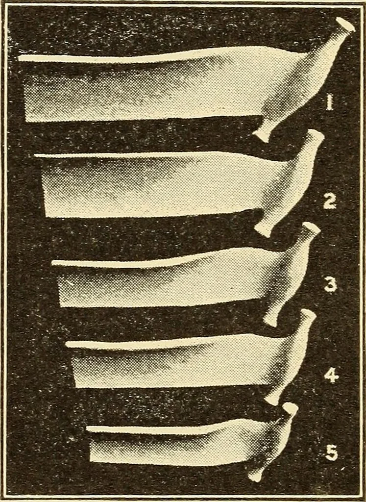 An illustration from Fractures and dislocations, diagnosis and treatment, 1915, leaf 297