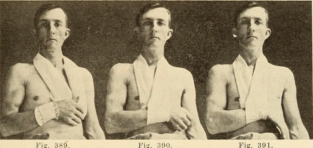 An illustration from Fractures and dislocations, diagnosis and treatment, 1915, leaf 298