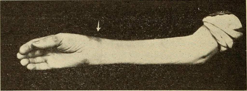 An illustration from Fractures and dislocations, diagnosis and treatment, 1915, leaf 305