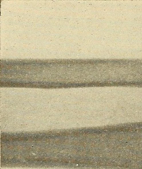An illustration from Fractures and dislocations, diagnosis and treatment, 1915, leaf 305