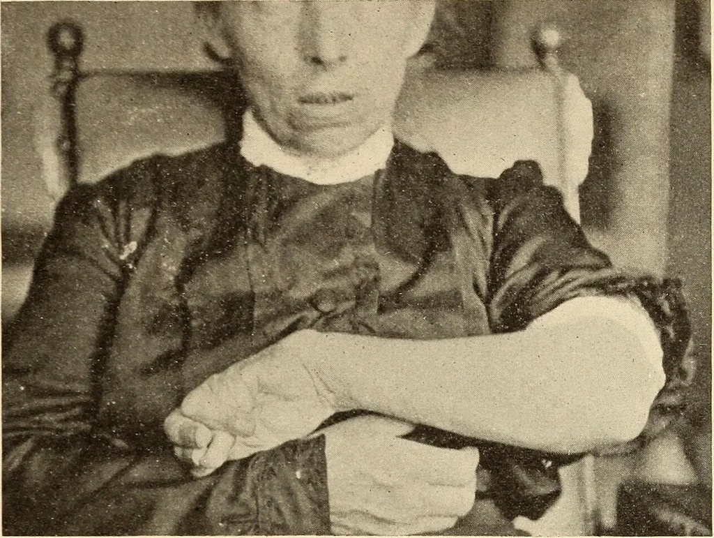 An illustration from Fractures and dislocations, diagnosis and treatment, 1915, leaf 306