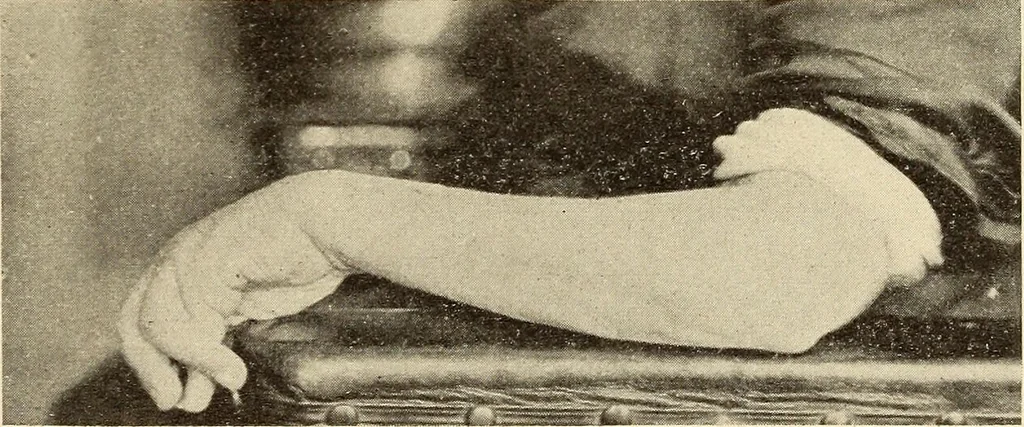 An illustration from Fractures and dislocations, diagnosis and treatment, 1915, leaf 306