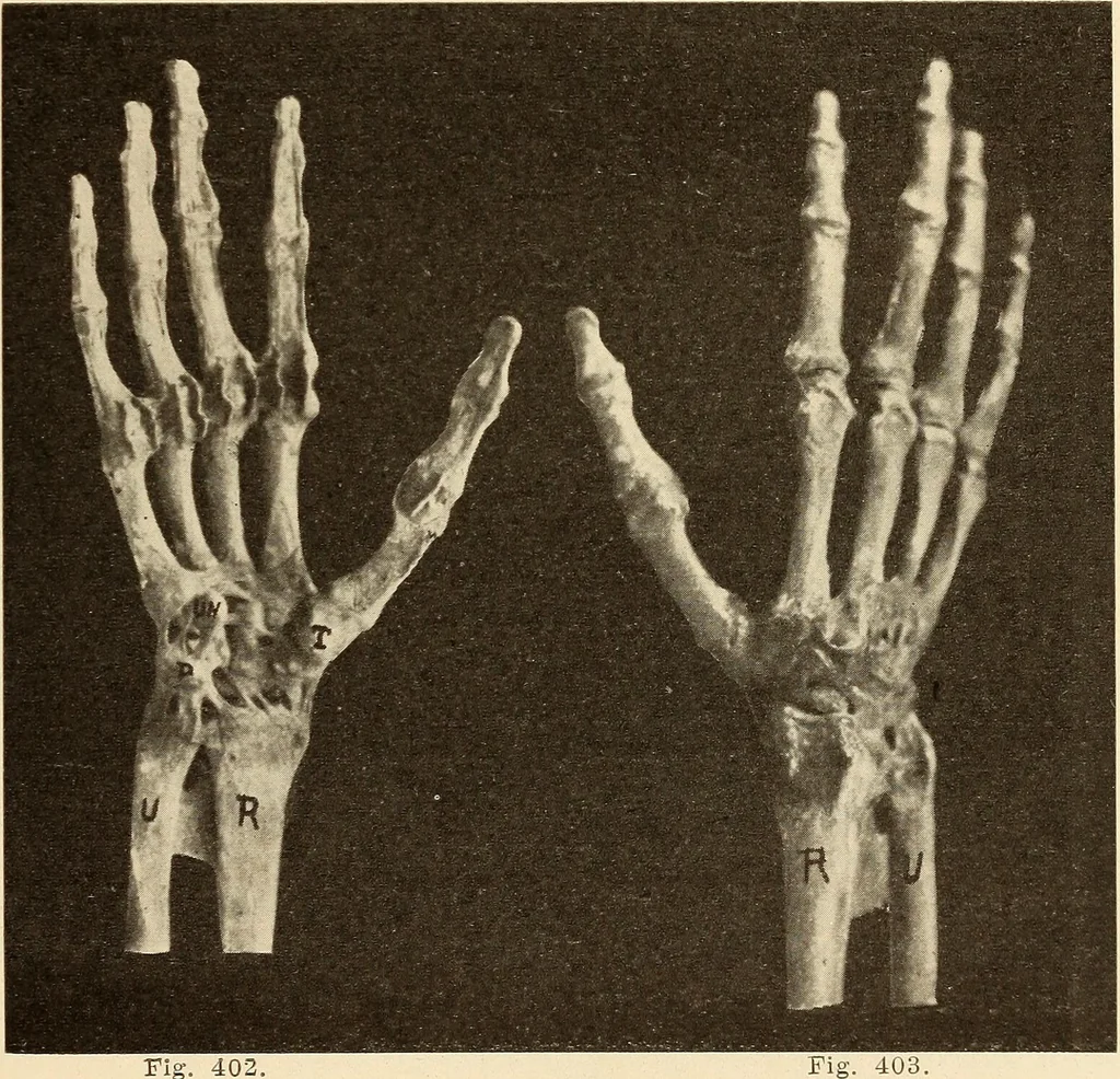 An illustration from Fractures and dislocations, diagnosis and treatment, 1915, leaf 308