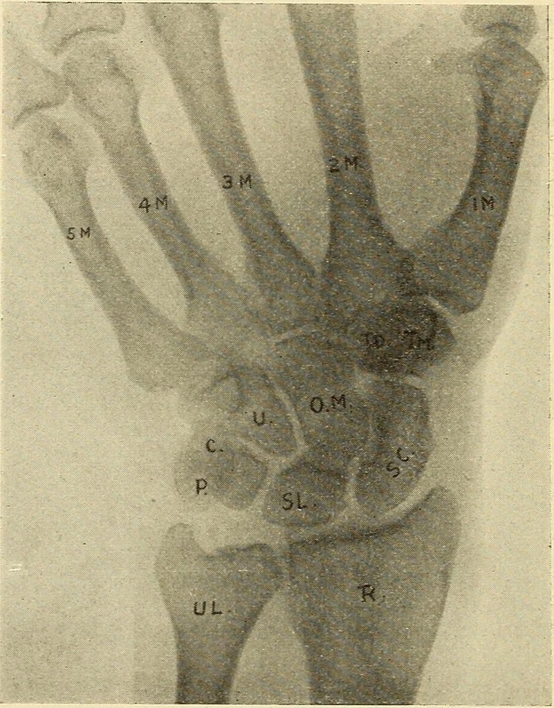 An illustration from Fractures and dislocations, diagnosis and treatment, 1915, leaf 309