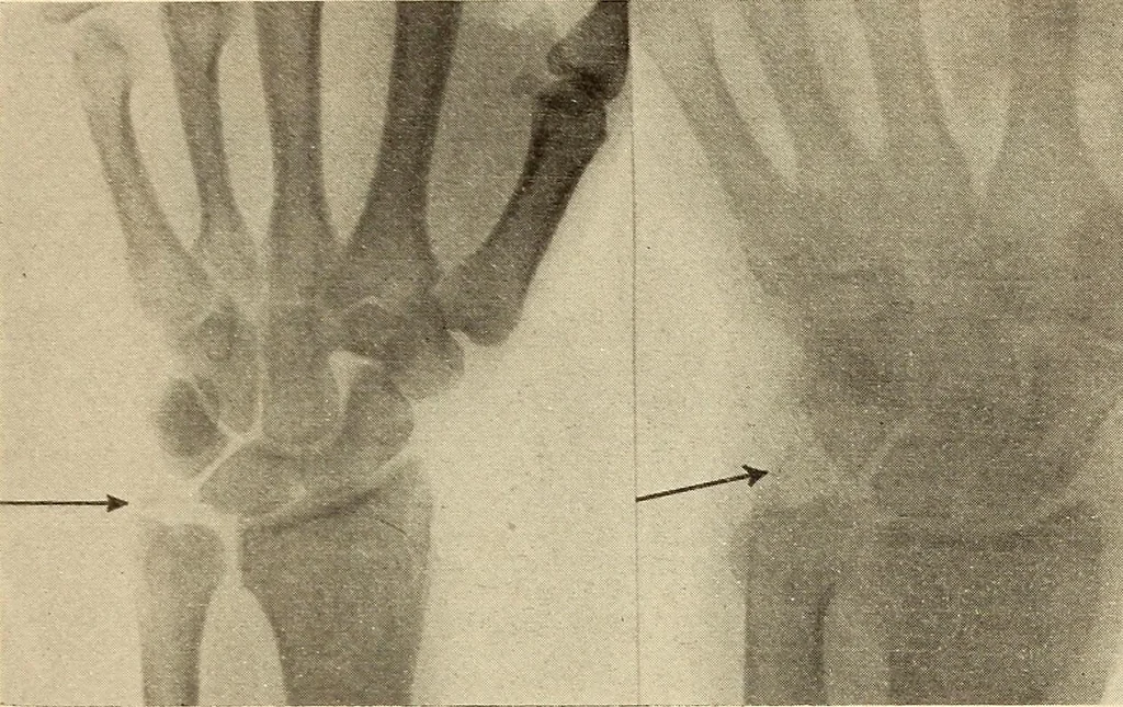 An illustration from Fractures and dislocations, diagnosis and treatment, 1915, leaf 310