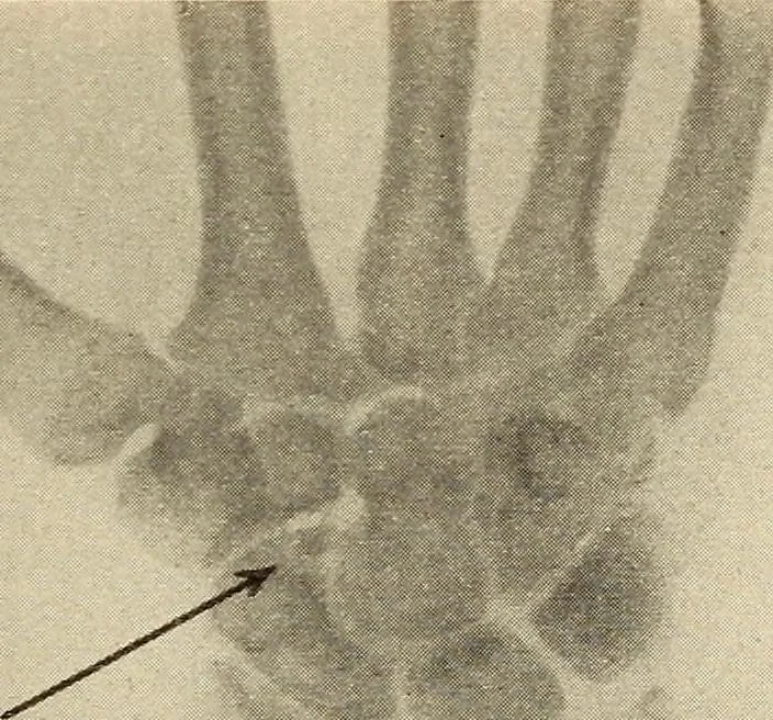 An illustration from Fractures and dislocations, diagnosis and treatment, 1915, leaf 310