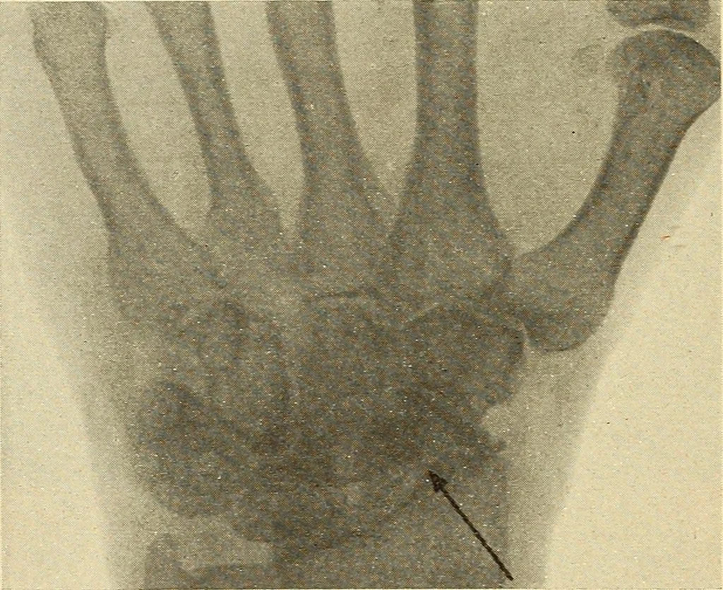 An illustration from Fractures and dislocations, diagnosis and treatment, 1915, leaf 311