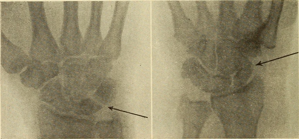 An illustration from Fractures and dislocations, diagnosis and treatment, 1915, leaf 311