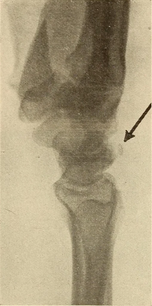 An illustration from Fractures and dislocations, diagnosis and treatment, 1915, leaf 312