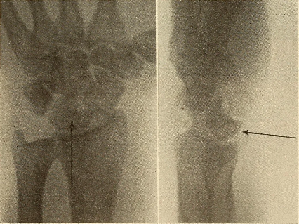 An illustration from Fractures and dislocations, diagnosis and treatment, 1915, leaf 312