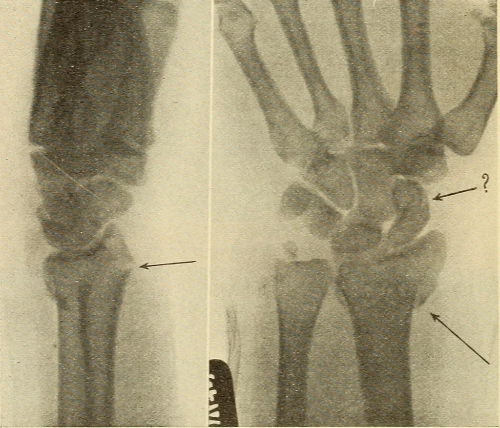 An illustration from Fractures and dislocations, diagnosis and treatment, 1915, leaf 313