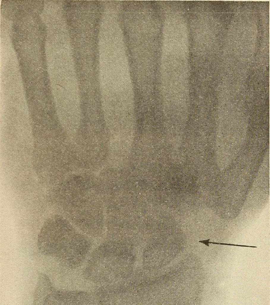 An illustration from Fractures and dislocations, diagnosis and treatment, 1915, leaf 314