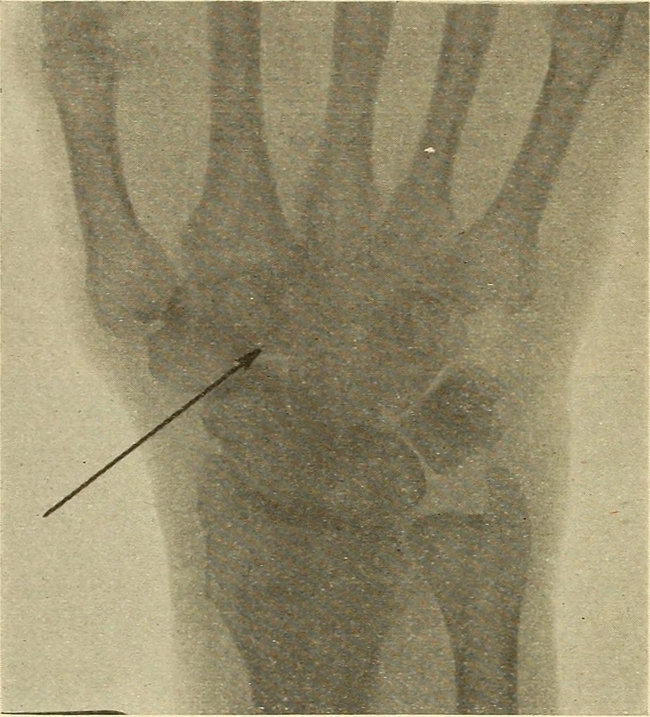 An illustration from Fractures and dislocations, diagnosis and treatment, 1915, leaf 315