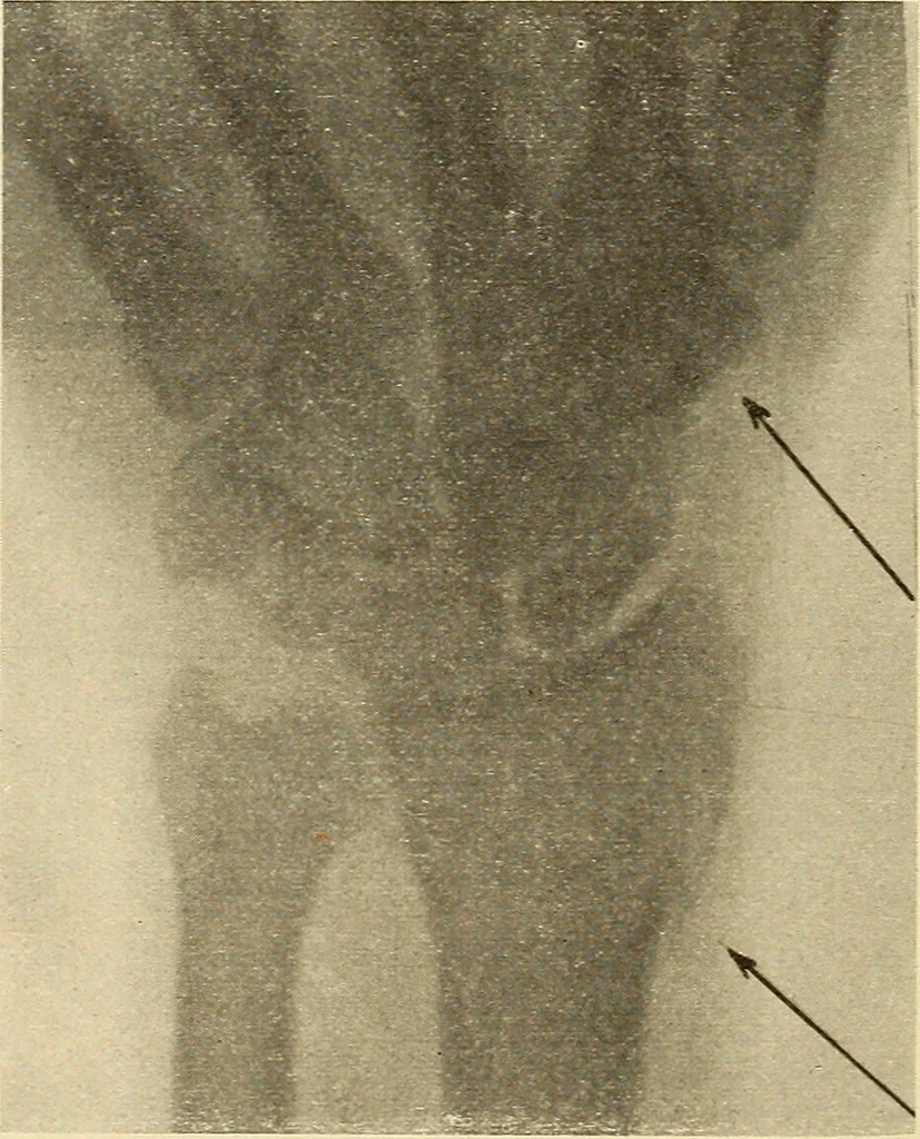 An illustration from Fractures and dislocations, diagnosis and treatment, 1915, leaf 315