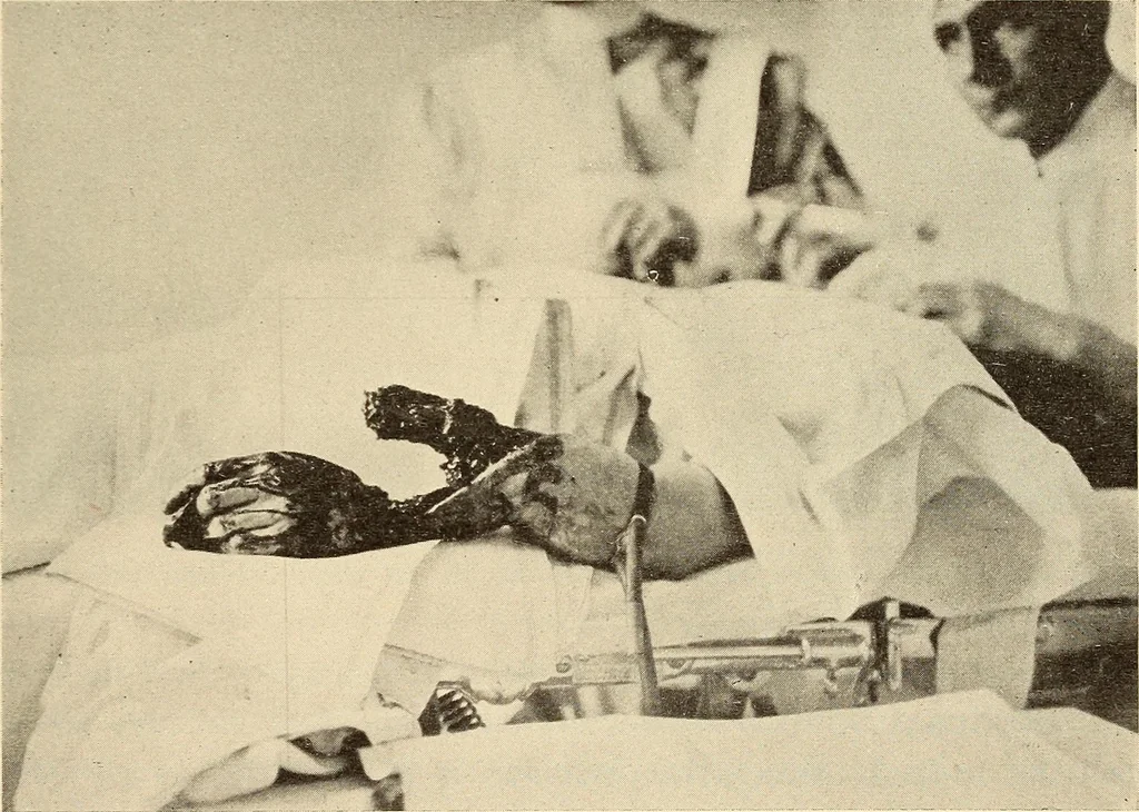 An illustration from Fractures and dislocations, diagnosis and treatment, 1915, leaf 318