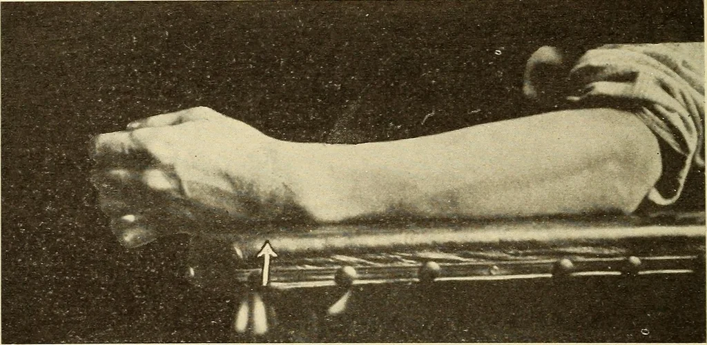 An illustration from Fractures and dislocations, diagnosis and treatment, 1915, leaf 319