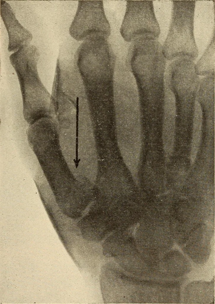 An illustration from Fractures and dislocations, diagnosis and treatment, 1915, leaf 328