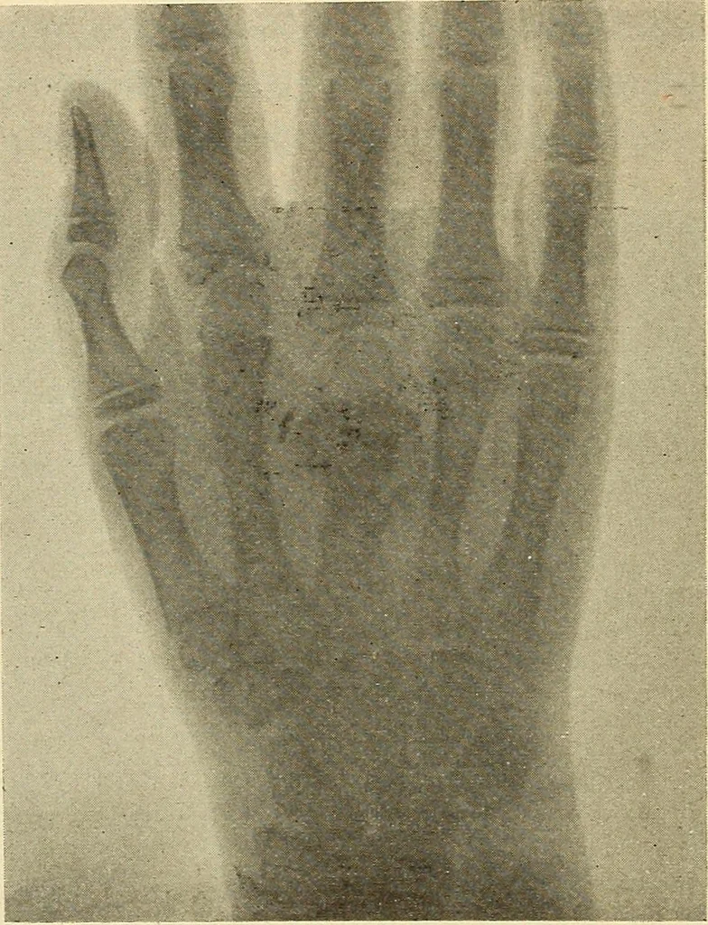 An illustration from Fractures and dislocations, diagnosis and treatment, 1915, leaf 329